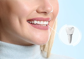 Nose-to-neck view of woman smiling with front tooth indicated as dental implant